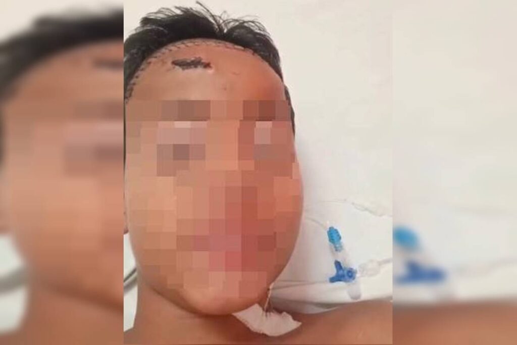 Menino de 11 anos espancado por gangue no lugar do irmão recebe alta