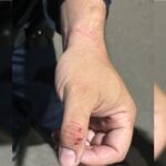 Veja como ficaram criança e policial atacados por pit-bulls no DF